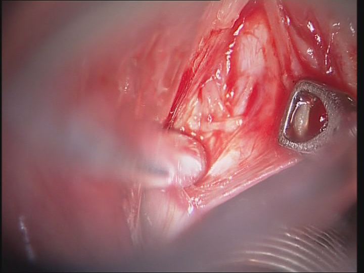 Fotos clínicas: Microcirugía endolaríngea.Cuerda cicatricial